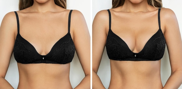 Cropped shot of young tanned woman in bra before and after breast augmentation with silicone implant