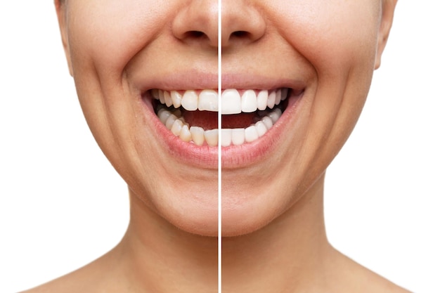 Cropped shot of young woman before and after veneers installation. Comparison of the shape of teeth