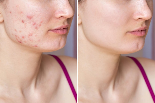 Photo cropped shot of young woman's face before and after acne treatment on face problem skin health care