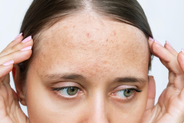 Cropped shot of young woman's face with acne problem, red allergic rash on the forehead