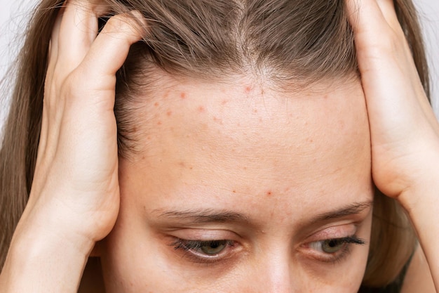 이마에 여드름 여드름 문제가 있는 젊은 여성의 얼굴을 자른 사진 알레르기