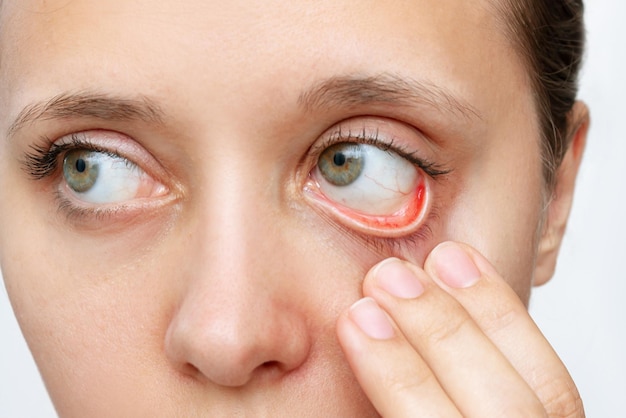 Cropped shot of a young woman showing off her red inflamed conjunctiva and dilated capillaries