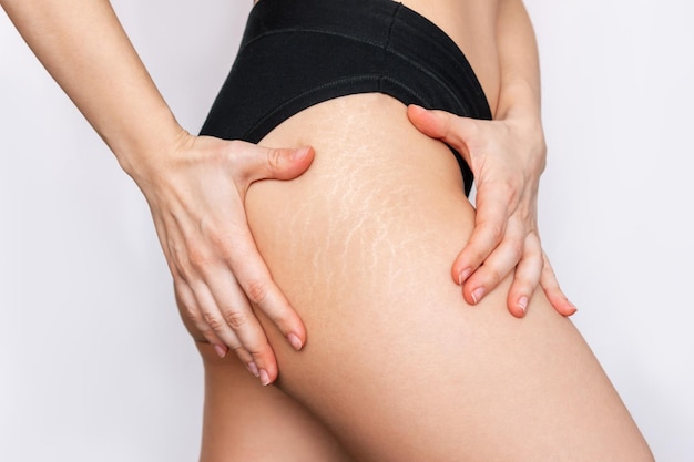 cropped shot of young woman with white stretch marks from a weight loss or weight gain on her thigh