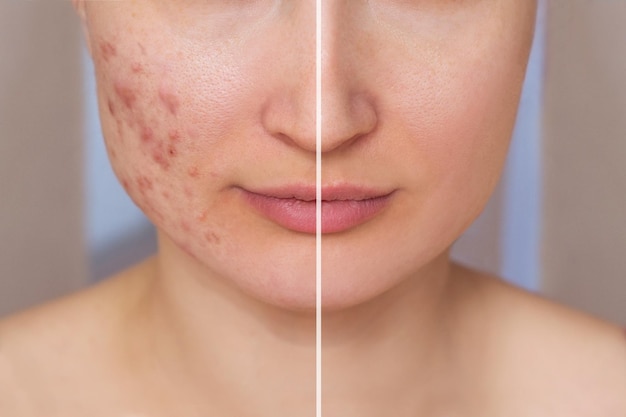 Cropped shot of a young womans face before and after acne treatment on the face