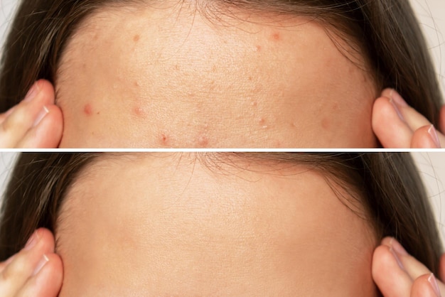 Cropped shot of a young womans face before and after acne\
treatment on forehead pimples rash
