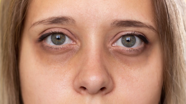 Photo cropped shot of a young womans face green eyes with dark circles under the eyes