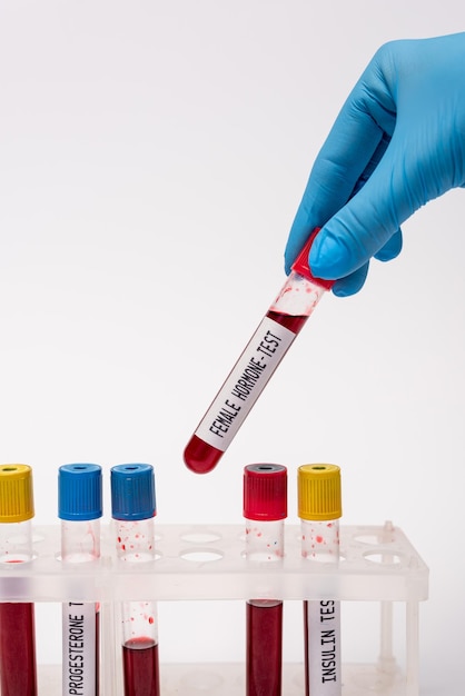 Cropped view of doctor holding test tube with female hormone test near blood samples in stand