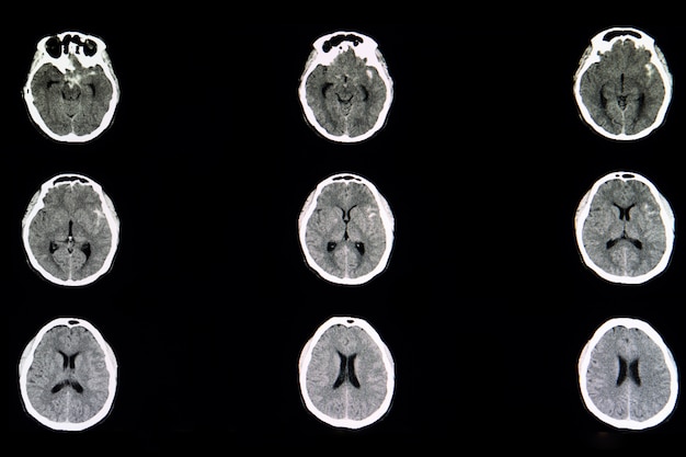 CT brain scan of ruptured cerebral aneurysm