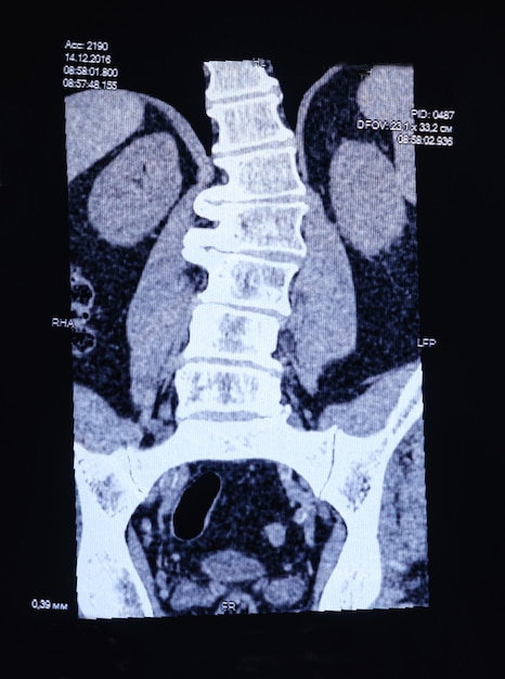 CT image of the spine of a patient with scoliosis