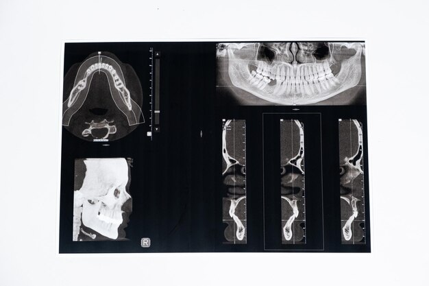 CT scan of a patient with malocclusion missing chewing tooth