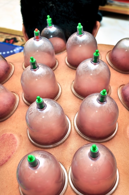 Cupping or Bekam Hijamah is traditional treatment