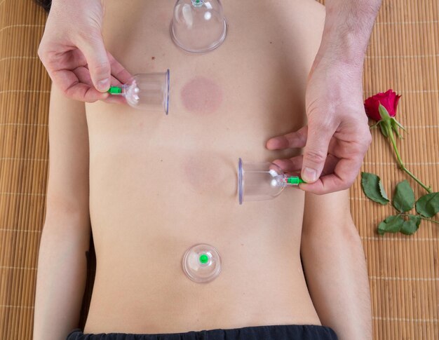 Cupping Chinese massage in een Chinese dokterskamer