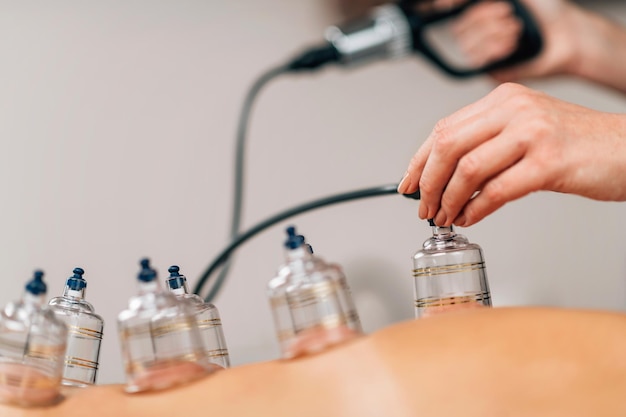 Cupping Therapy Hijama