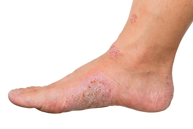 Cut out wounds and dry skin on human foot