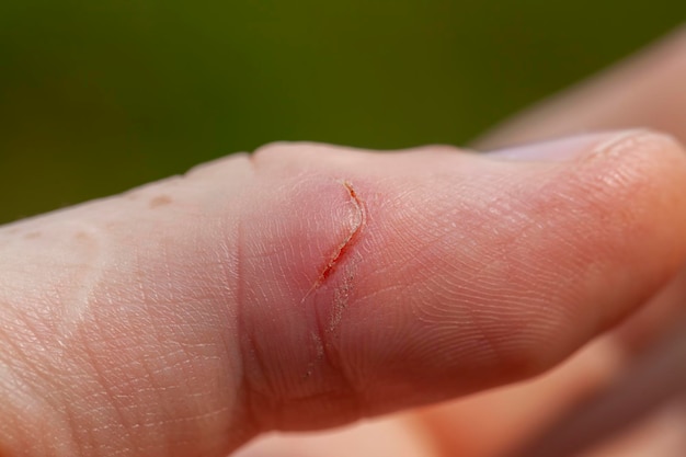 Photo a cut thumb on the hand close up