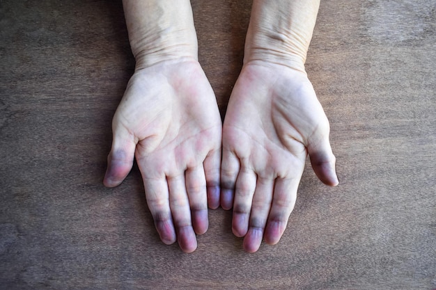 Photo cyanotic hands or peripheral cyanosis or blue hands at asian old woman with congenital heart disease