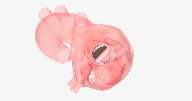 The damaged aortic valve may also be replaced with a mechanical or a biological tissue valve