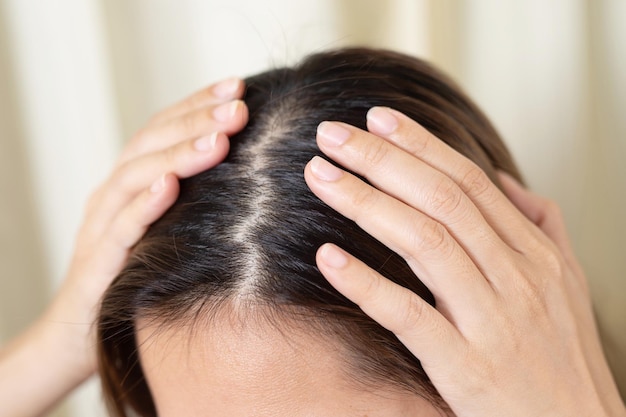 Photo dandruff is caused by yeast-like fungi (malassezia) living on your scalp.