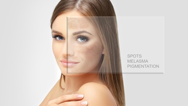 Dark spots freckles hyperpigmentation melasma or chloasma concept skin lightening