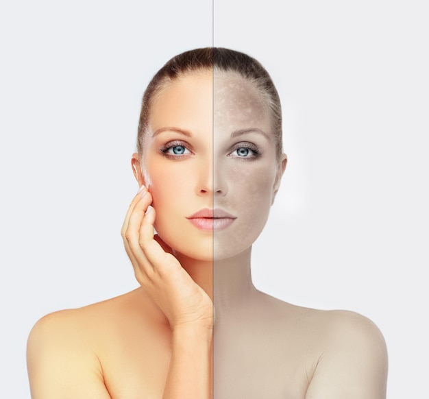 Dark spots hyperpigmentation melasma or chloasma concept skin lightening
