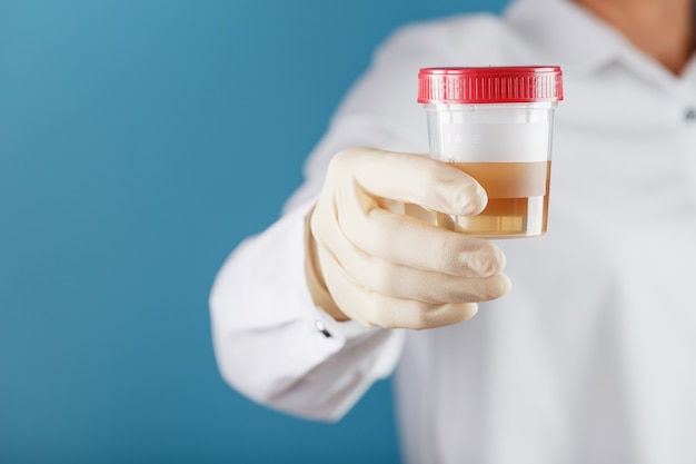 De dokter houdt een plastic blikje urine vast voor analyse