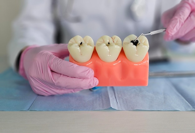 De dokter spreekt over tandcaries en plaque het proces van demineralisatie oplossingen