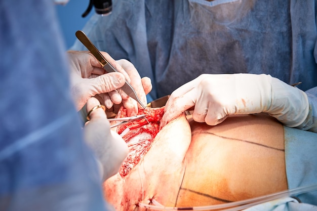 Foto de dokter voert een operatie uit om de vrouwelijke borst van een plastische chirurg te reconstrueren