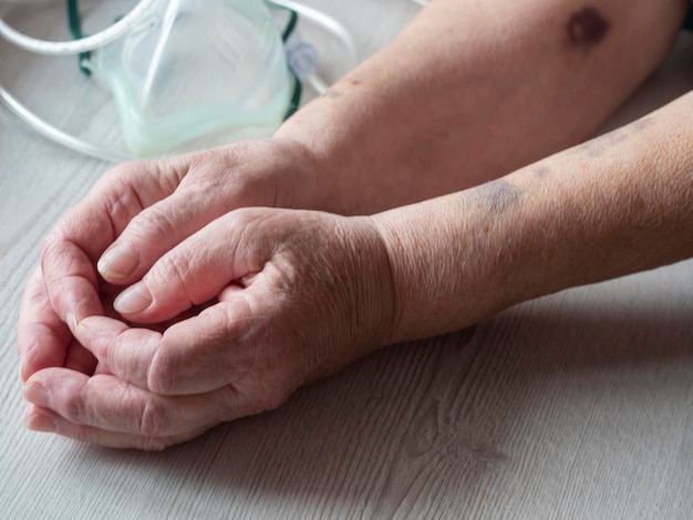 Foto de handen van een oudere vrouw met covid-19 zijn gekneusd door meerdere intraveneuze vloeistoffen tijdens de ziekenhuisopname.