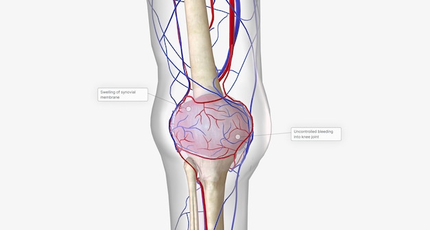 De hemofilie die in het gewricht bloedt