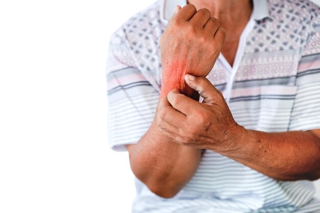 De pols van een oudere man heeft rode uitslag die jeuk veroorzaakt door allergie voor bepaalde stoffen