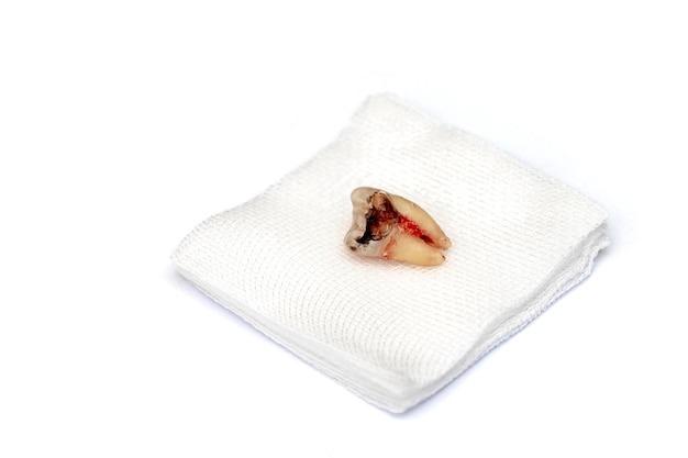 A decayed molar tooth is extracted The blood hasn't dried yet Lie down on white gauze Isolated on a white background Selective focus