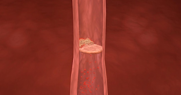 Deep vein thrombosis and pulmonary embolism