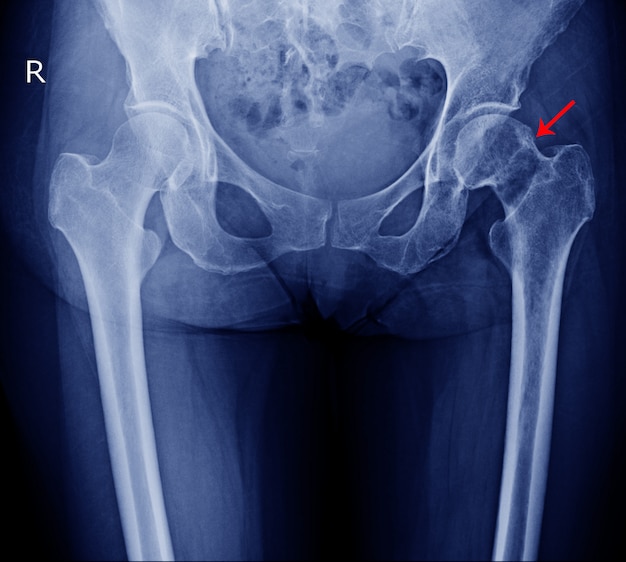 Defined rarefaction of left femoral head and neck