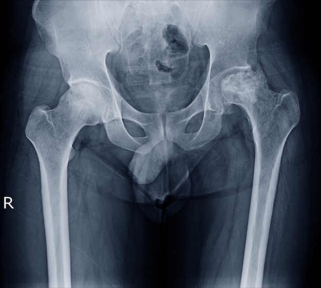 Photo defined rarefaction of left femoral head and neck