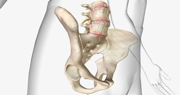 Foto degeneratieve spondylolisthesis is een orthopedische aandoening die wordt gekenmerkt door het voorwaarts wegglijden van een wervel