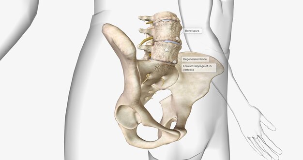 写真 変性脊椎すべり症は、椎骨の前方滑りを特徴とする整形外科的疾患です。