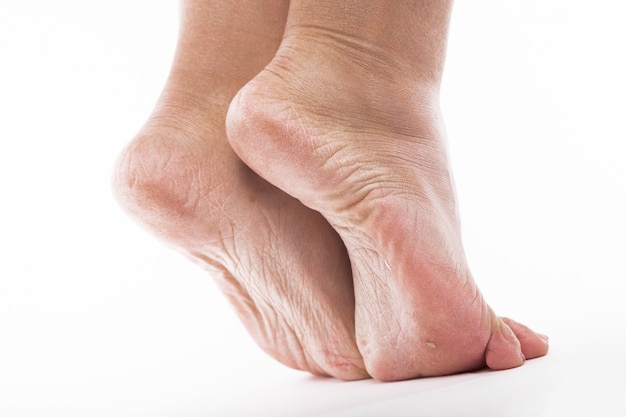 Dehydrated skin on the heels of female feet