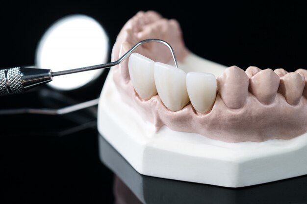 demonstratietanden model van variëteiten van prosthodontische beugel of brace