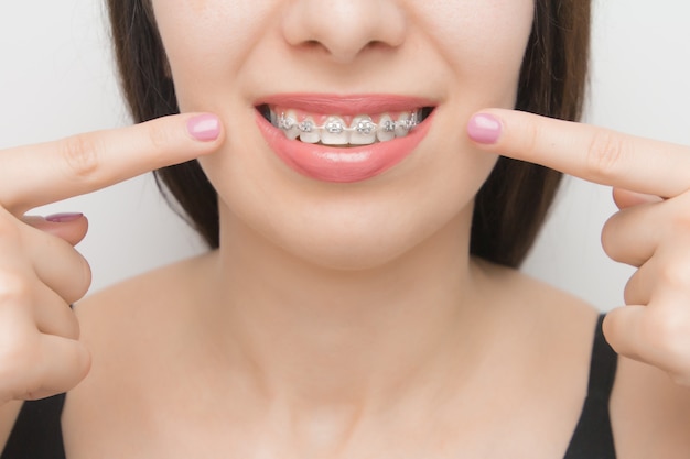 Parentesi graffe dentali nella bocca della donna felice che mostra con due dita sulle parentesi sui denti dopo lo sbiancamento. staffe autoleganti con fascette metalliche ed elastici grigi o elastici per un sorriso perfetto