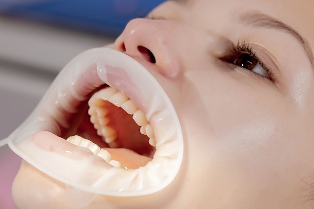 Dental cap. Professional cleaning of the space between the teeth. Young girl at the dentist's appointment. Prevention of caries and gum disease.