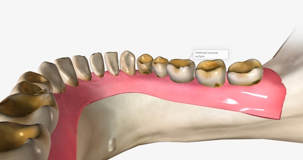 Dental erosion also known as tooth erosion