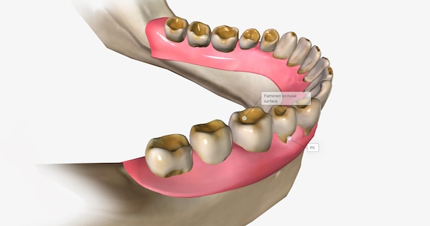 Photo dental erosion also known as tooth erosion