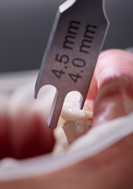 Foto altimetro dentale fotografia macro immagine in primo piano verticale di uno strumento di misura dentale denti con parentesi e labbro inferiore con retrattore delle guance concetto di odontoiatria e trattamento ortodontico