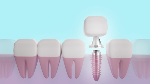 Dental implant 3d rendering image for medical content