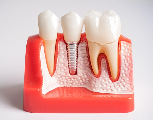 Dental implant artificial tooth roots into jaw root canal of dental treatment gum disease teeth