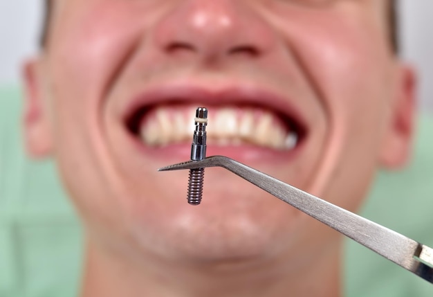 Dental implant in tweezers