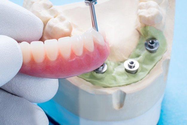 Photo dental implant work is completed and ready to use/ dental implant temporary abutment