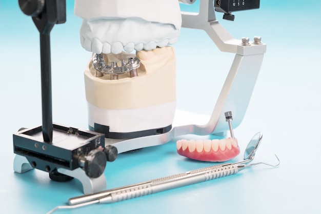 Зубная имплантация завершена и готова к использованию.