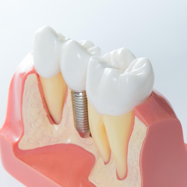 Dental implant