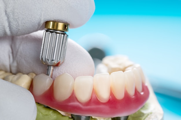 Photo dental implants supported overdenture.